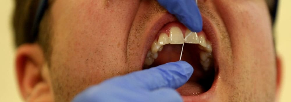 치실이 치아 건강에 중요한 이유와 올바른 사용법